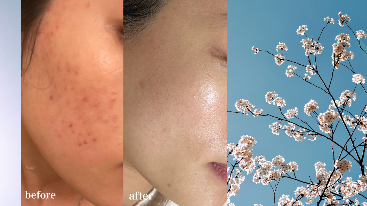 赤ニキビ改善のためのスキンケア、始めませんか？